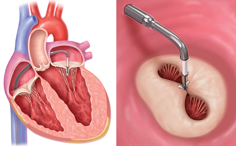 After the clip is gradually advanced below the valve leaflets (left), it is retracted and closed (right) to hold the leaflets together and allow blood to flow through each opening. Reproduced with permission of Abbott.